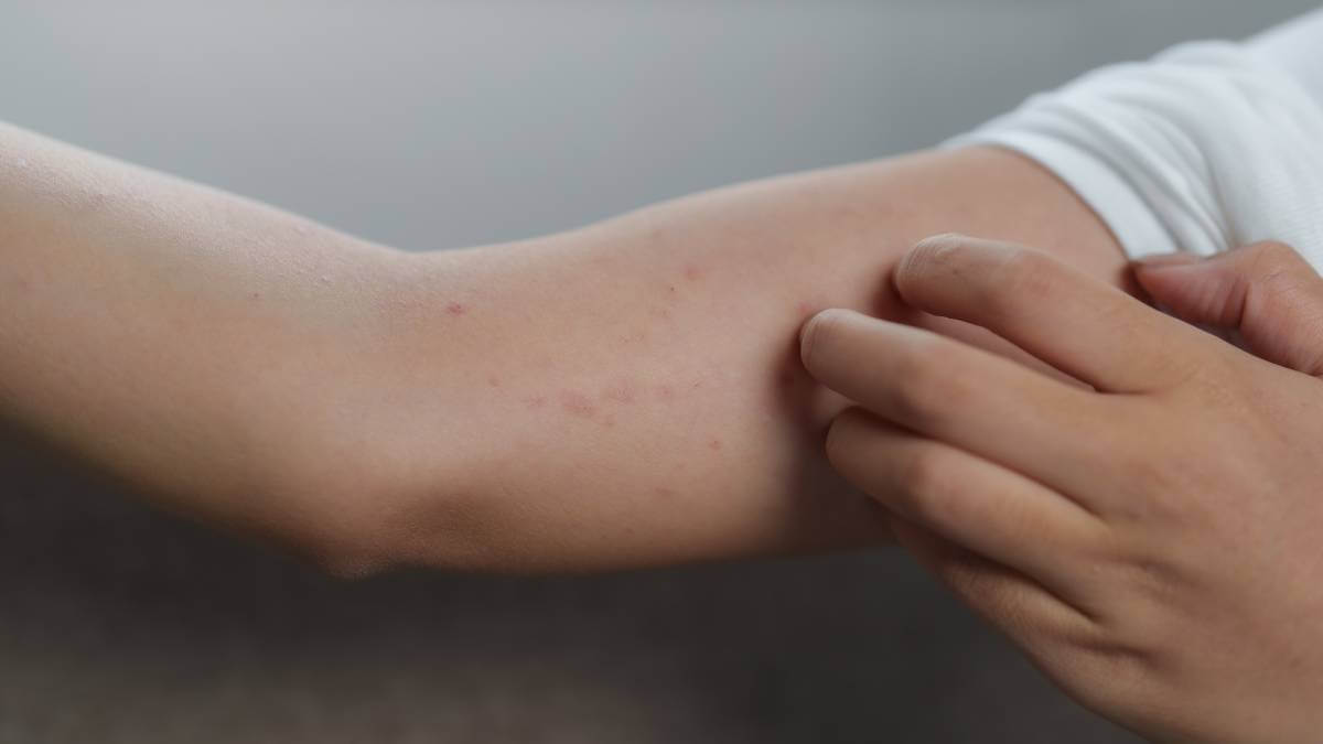 Itching Rash On Upper Arm