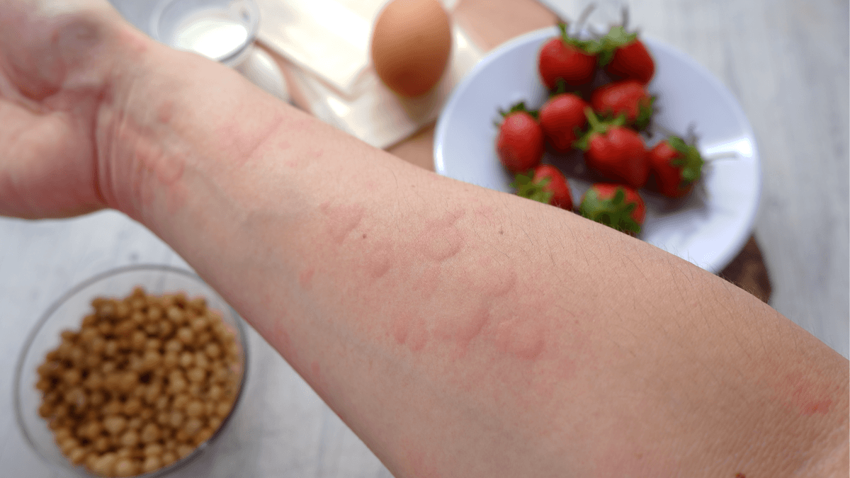 arm closeup allergic reaction
